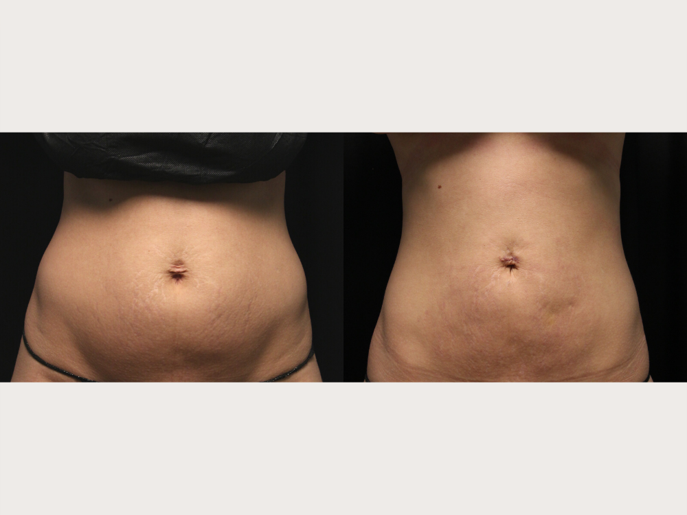 Body Contouring Before and After Photos by Michael Frederick, MD; Fort  Lauderdale, FL - Case 35889