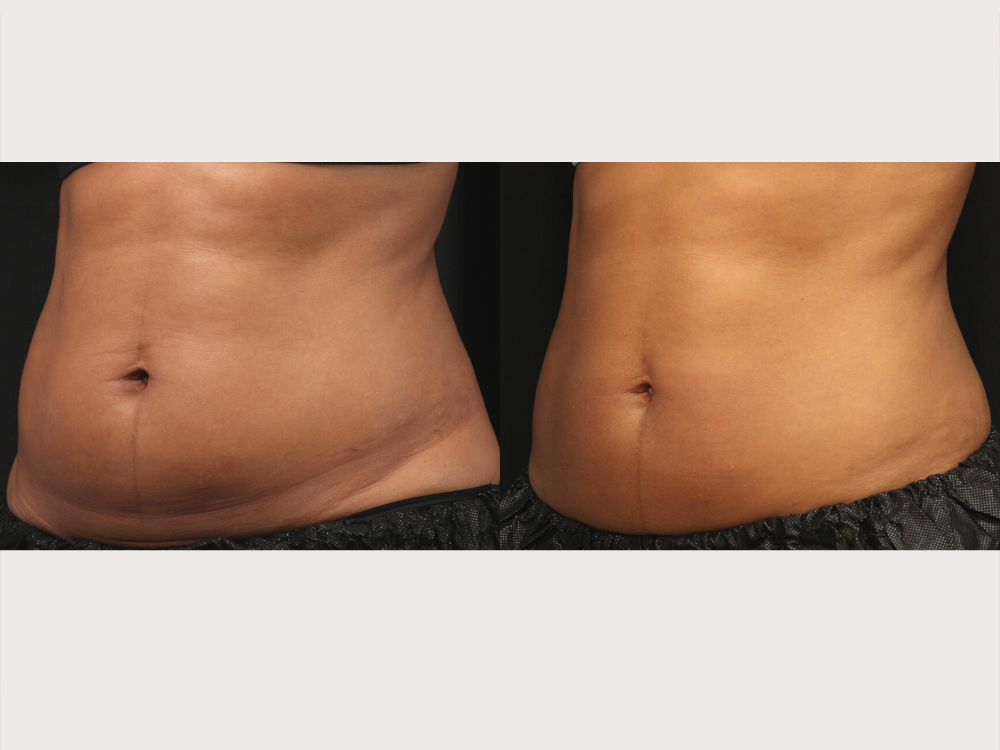 Body Contouring » Premier Dermatology