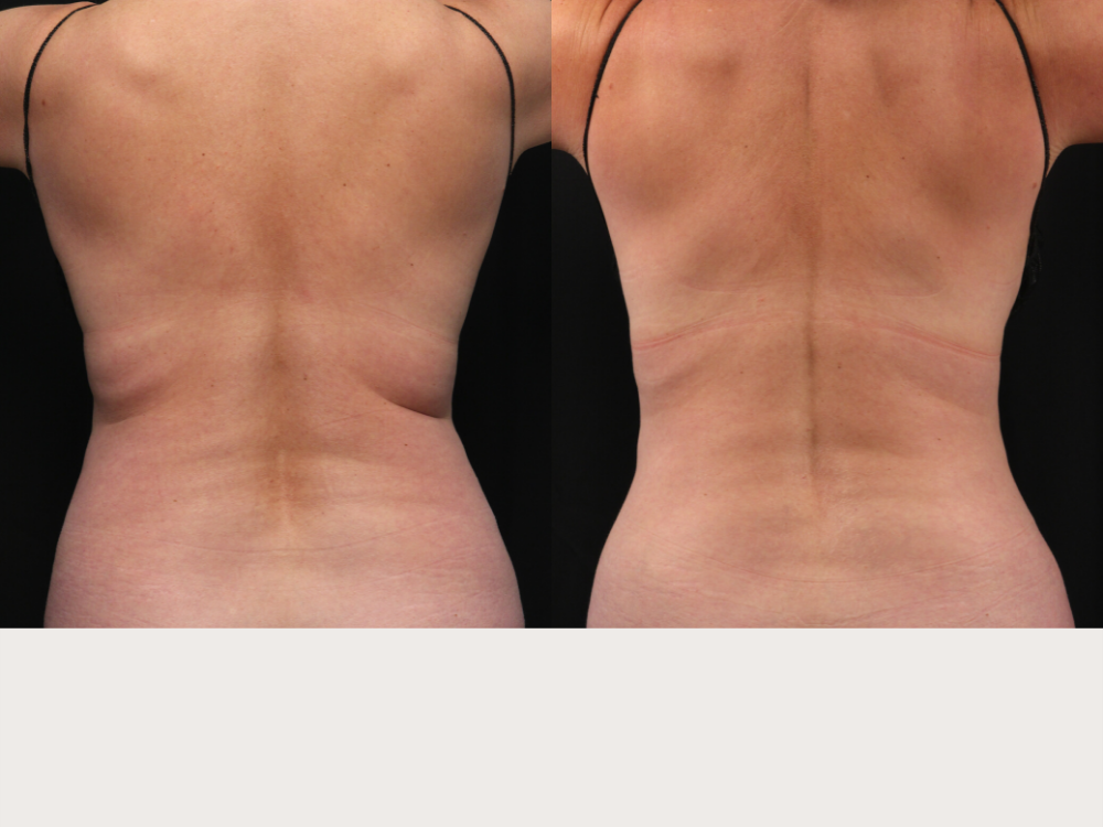 Posts tagged with body contouring - Southeastern Dermatology