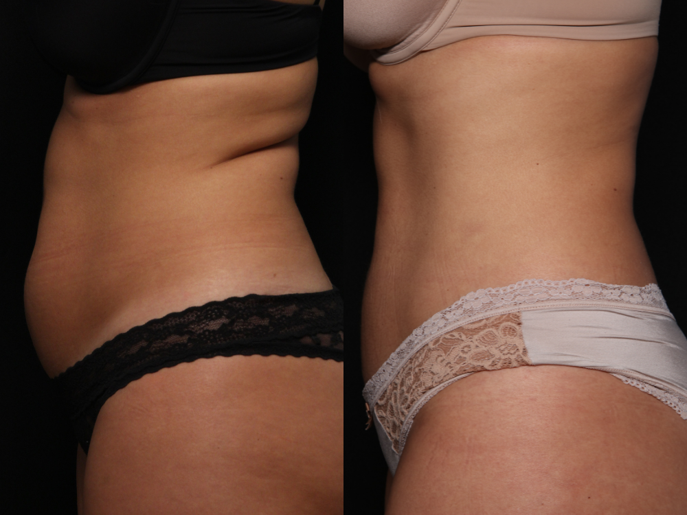 Body Contouring » Premier Dermatology