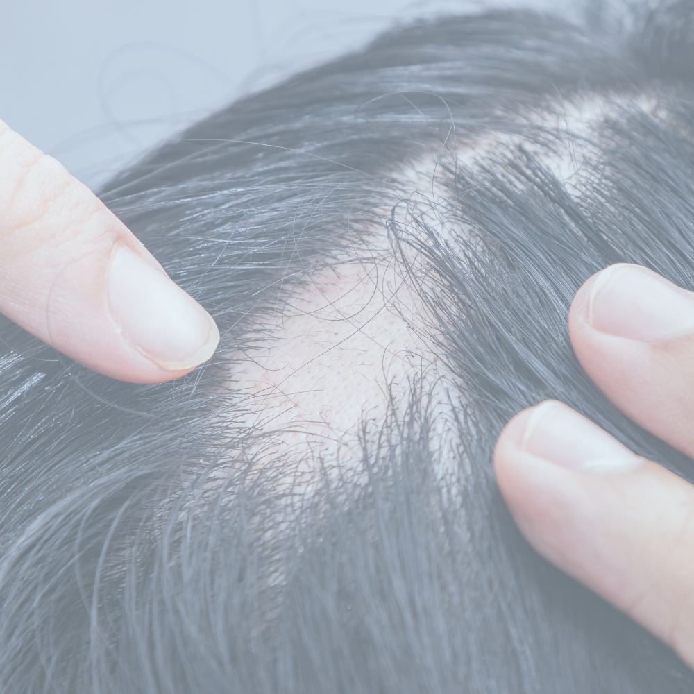 CTI Alopecia Areata