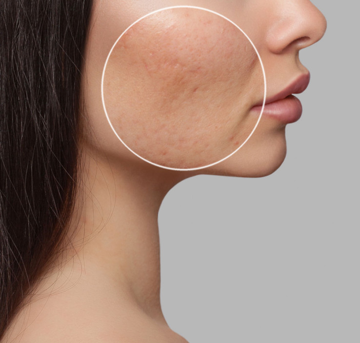 Fractora
