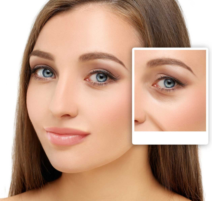 Blepharoplasty