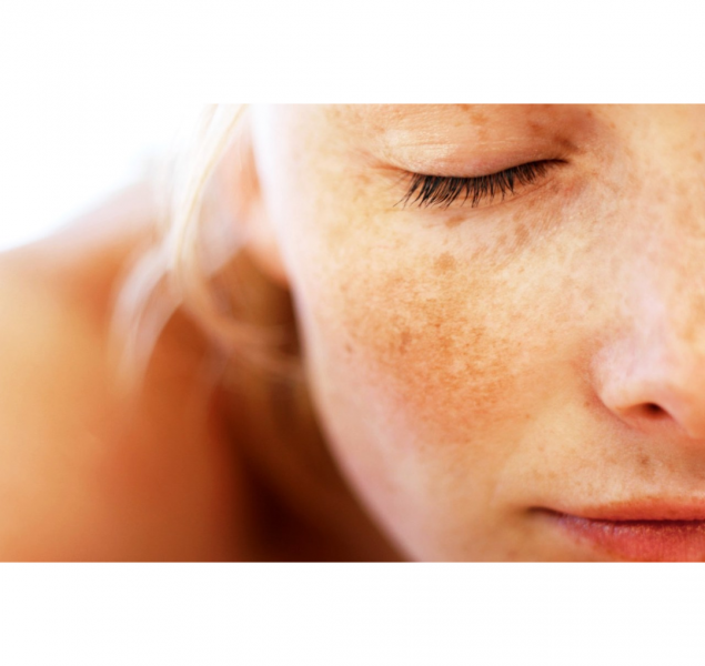 July is Melasma Awareness Month