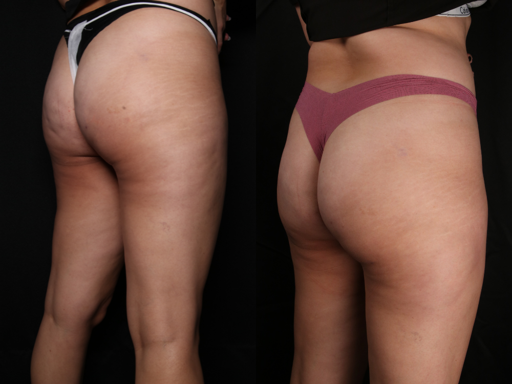 Comprehensive Guide To Avéli™ Long-Term Cellulite Treatment - Premier  Surgical Plastic Surgery