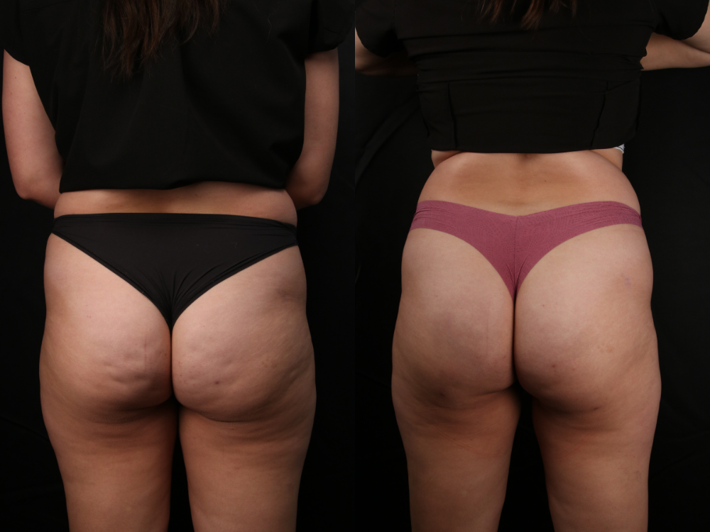 Comprehensive Guide To Avéli™ Long-Term Cellulite Treatment - Premier  Surgical Plastic Surgery