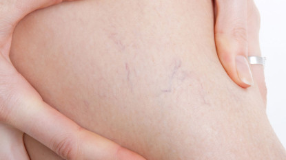 Sclerotherapy
