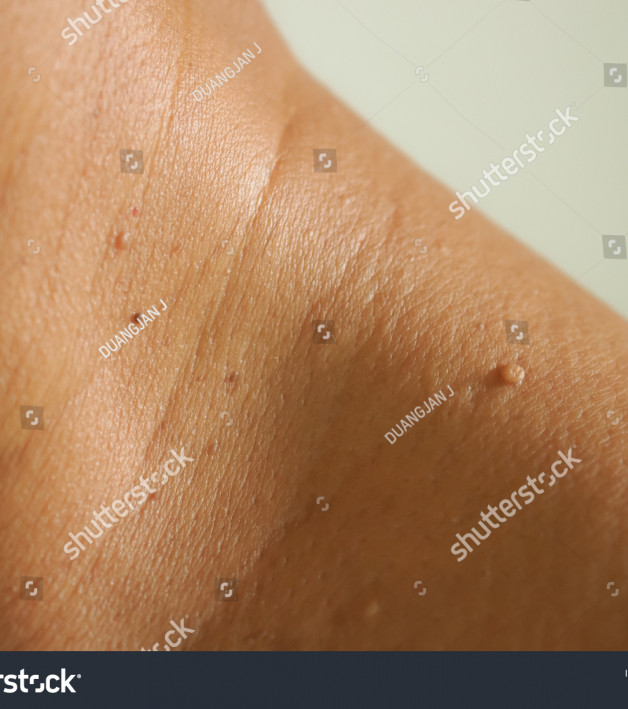 uddybe Sparsommelig Næste Skin Tags Conditions » Premier Dermatology